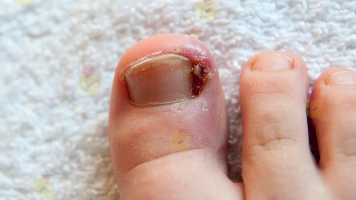 Comment Soulager Naturellement un Ongle Incarné